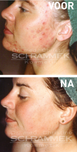 acne voor na 2